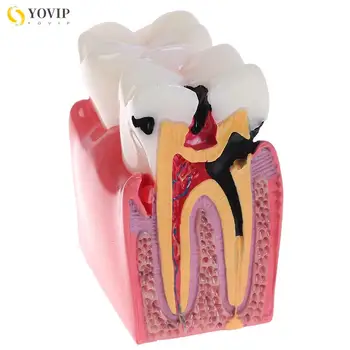 Лаборатория стоматологических материалов, 6 моделей для сравнительного исследования кариеса, модели для изучения стоматологов